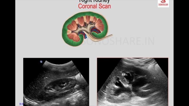 Sonography of Urinary Tract – Technique – Kidney& Renal Pelvis