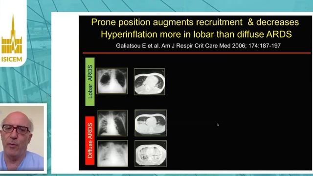 How to use PEEP in the prone position Paolo  Pelosi