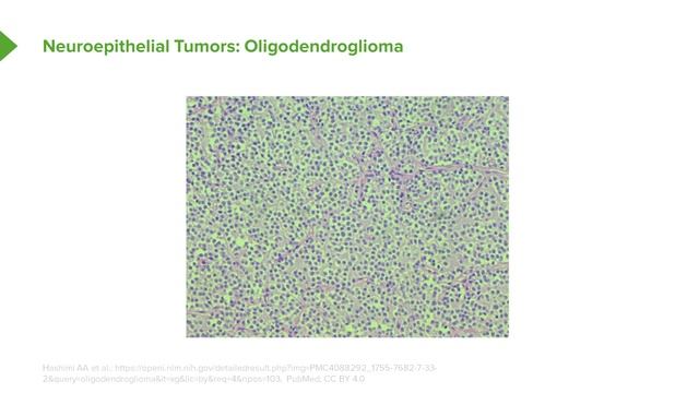 04. Neuroepithelial Tumors Oligodendroglioma