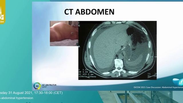 INTRA-ABDOMINAL HYPERTENSION Many Malbrain (ISICEM 2021 aug-sept)