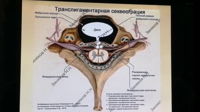 Вопрос 14: может ли транслигаментарная секвестрация диска уменьшиться?