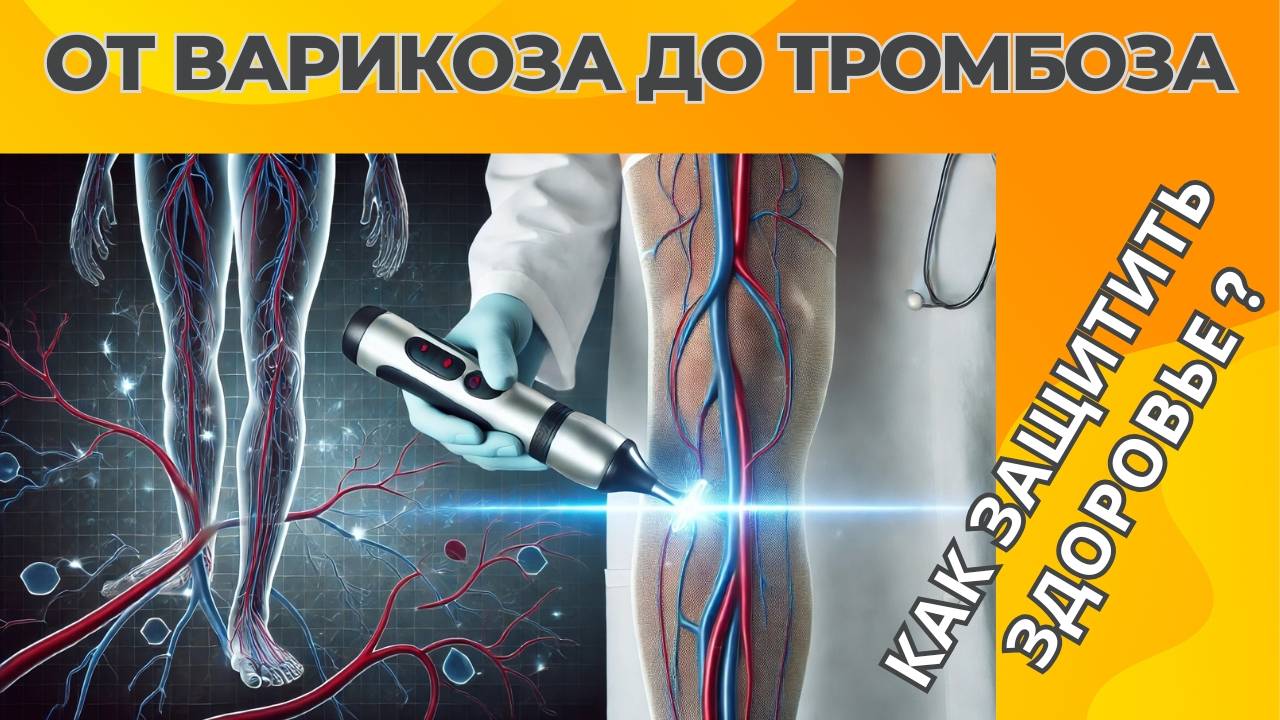 Варикоз   Как защитить здоровье?