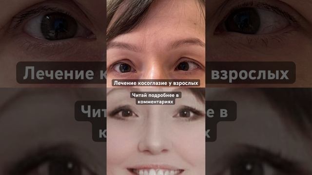 Лечение косоглазия у взрослых #офтальмолог #косоглазие