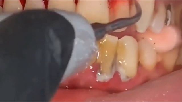 Teeth Tartar Scaling