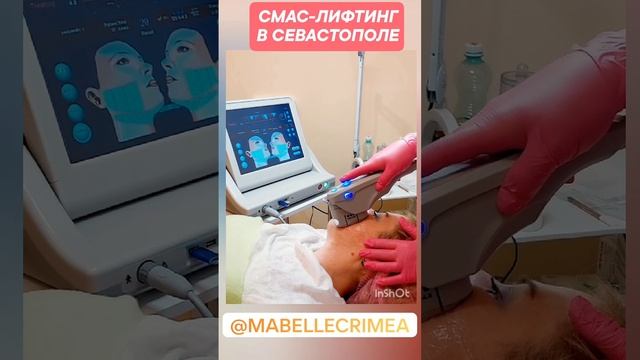 СМАС-лифтинг в Севастополе