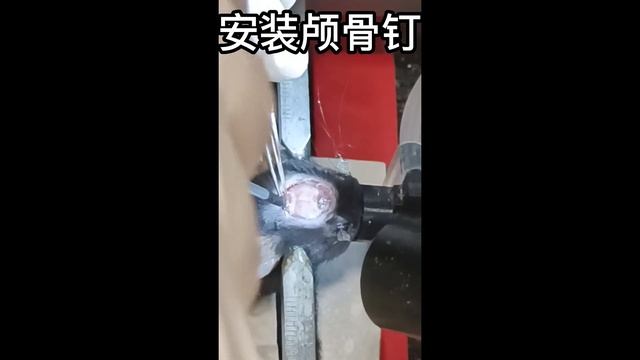 Video of the surgery for AR4