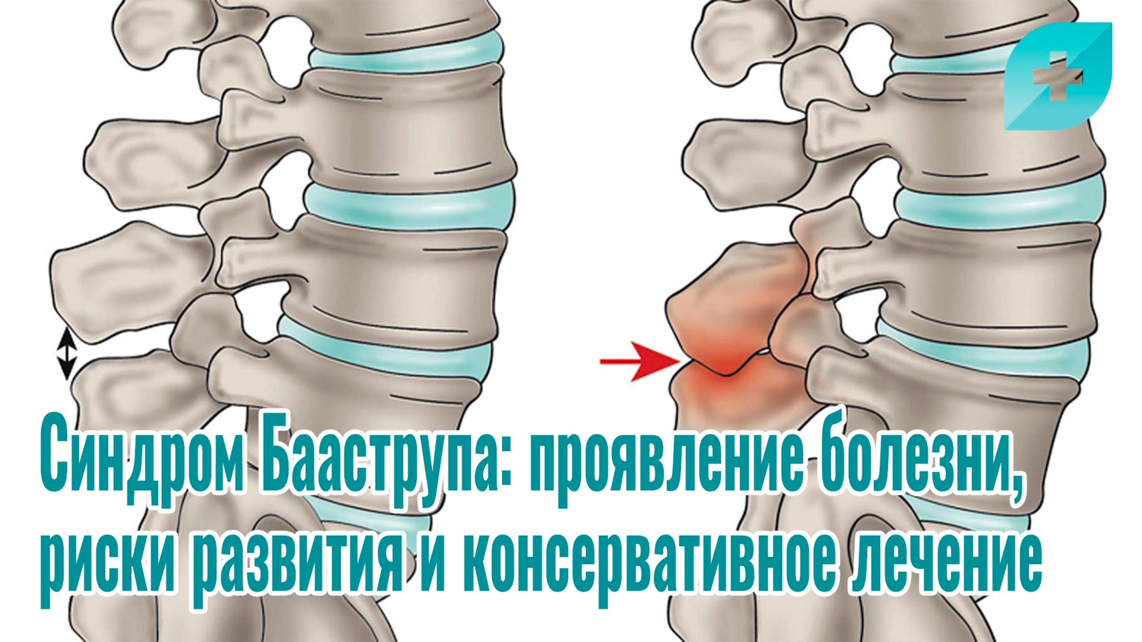 Синдром Бааструпа: проявление болезни, риски развития и консервативное лечение