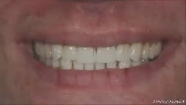 Виниры без обточки зубов. Veneers without teeth preparation. Emax. Carillas Dentales