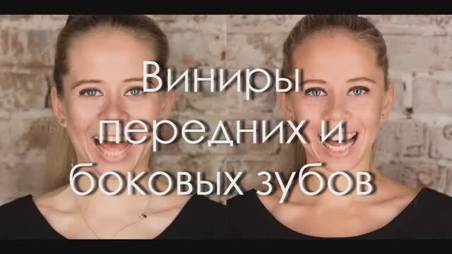 Виниры передних и боковых зубов. Esthet-X HD (Dentsply Syrona). Front teeth veneers.