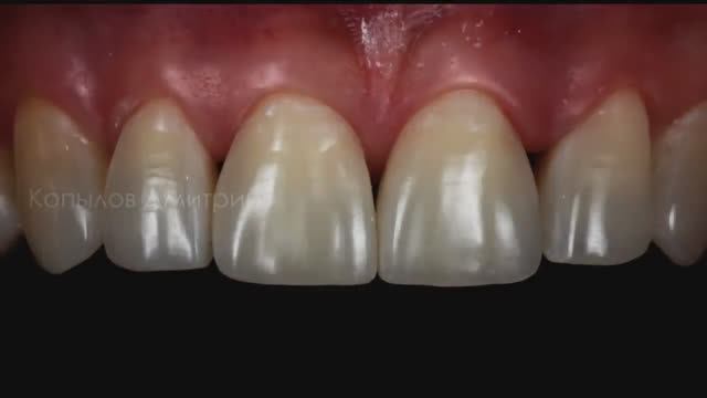 Закрытие щелей между зубами. Реставрация передних зубов. Front teeth restoration.