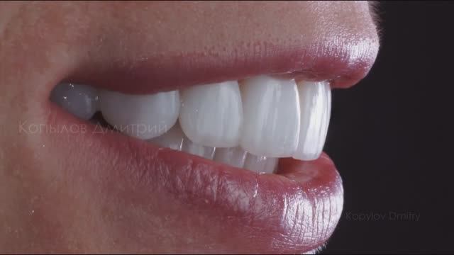 Керамические виниры без препарирования. Люминиры. Emax. Non prep veneers