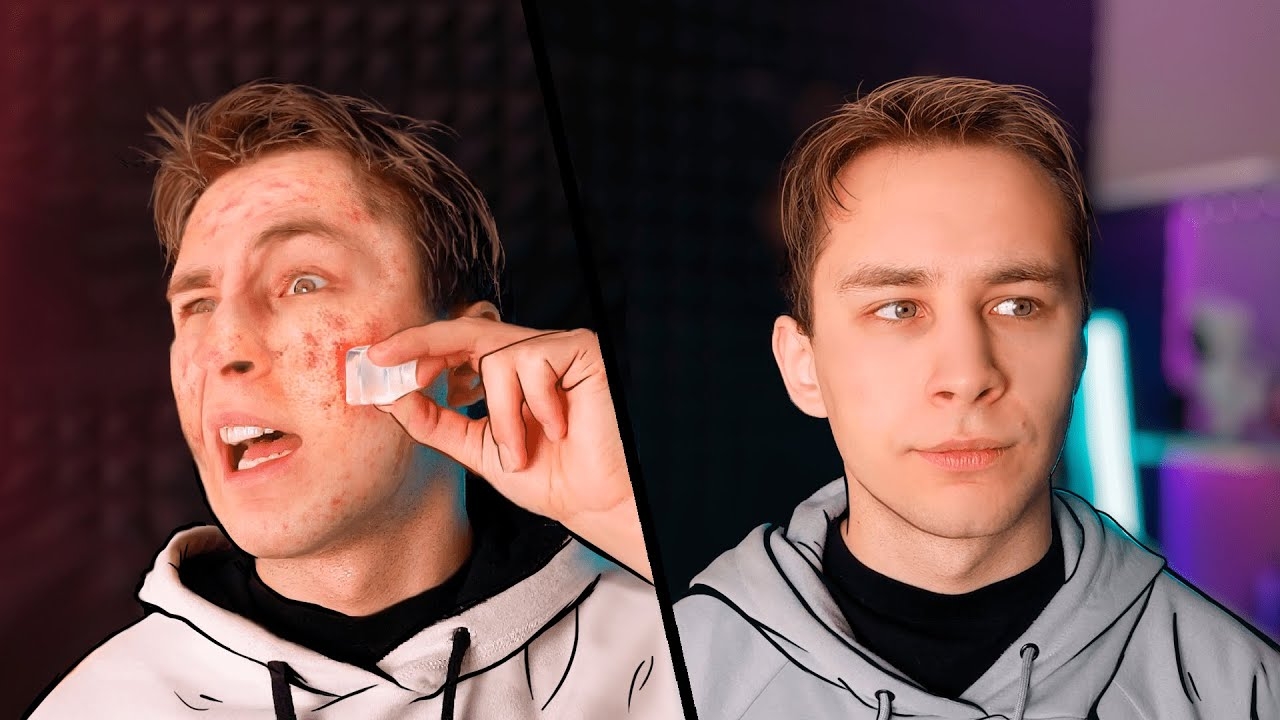 [Sergio Nee] Как Я Вылечил Прыщи За 30 Дней