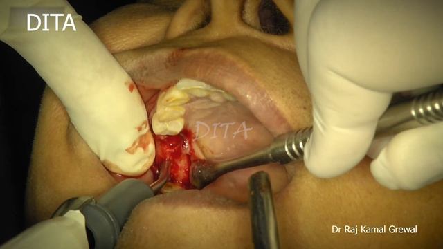 Crestal Approach (Indirect Sinus Lift) For Conventional Implant With Nova Bone Putty Graft