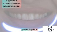 Реставрация передних зубов( ламинирование)