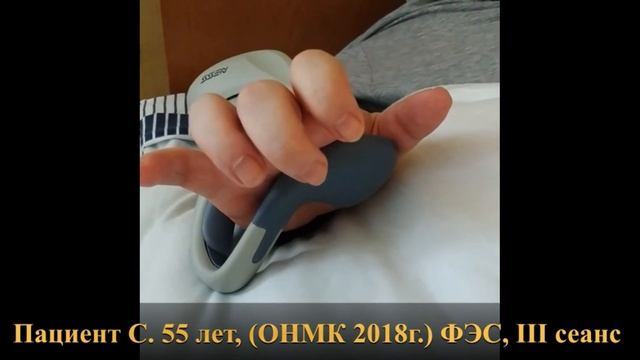 Демонстрация применения беспроводной системы ФЭС для мышц руки - Bioness H200 W.  Пациент 55 лет