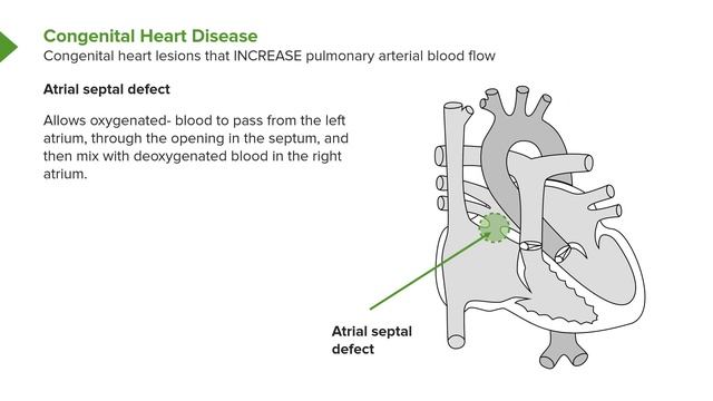 02. Congenital Heart Disease
