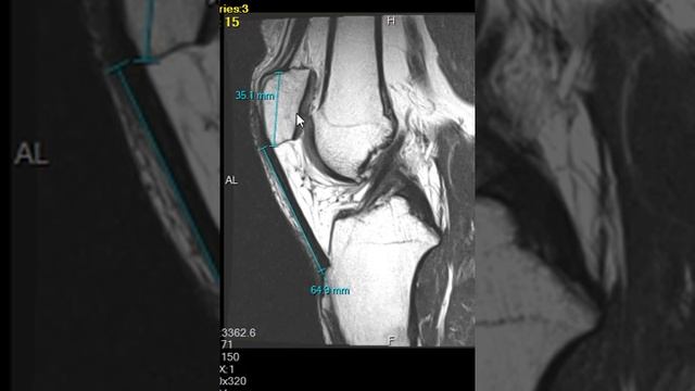 Patella Alta and Fatty Impingement