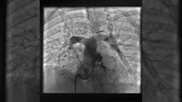 MPA Angiogram post bilateral pulmonary artery stent.avi