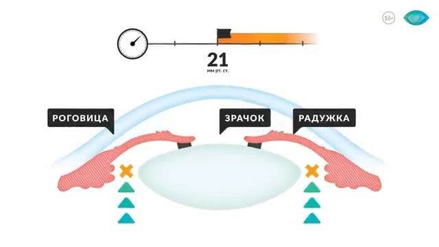 5 фактов об остром приступе глаукомы. Доктор Лапочкин.