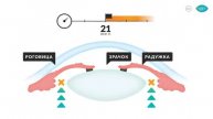 5 фактов об остром приступе глаукомы. Доктор Лапочкин.