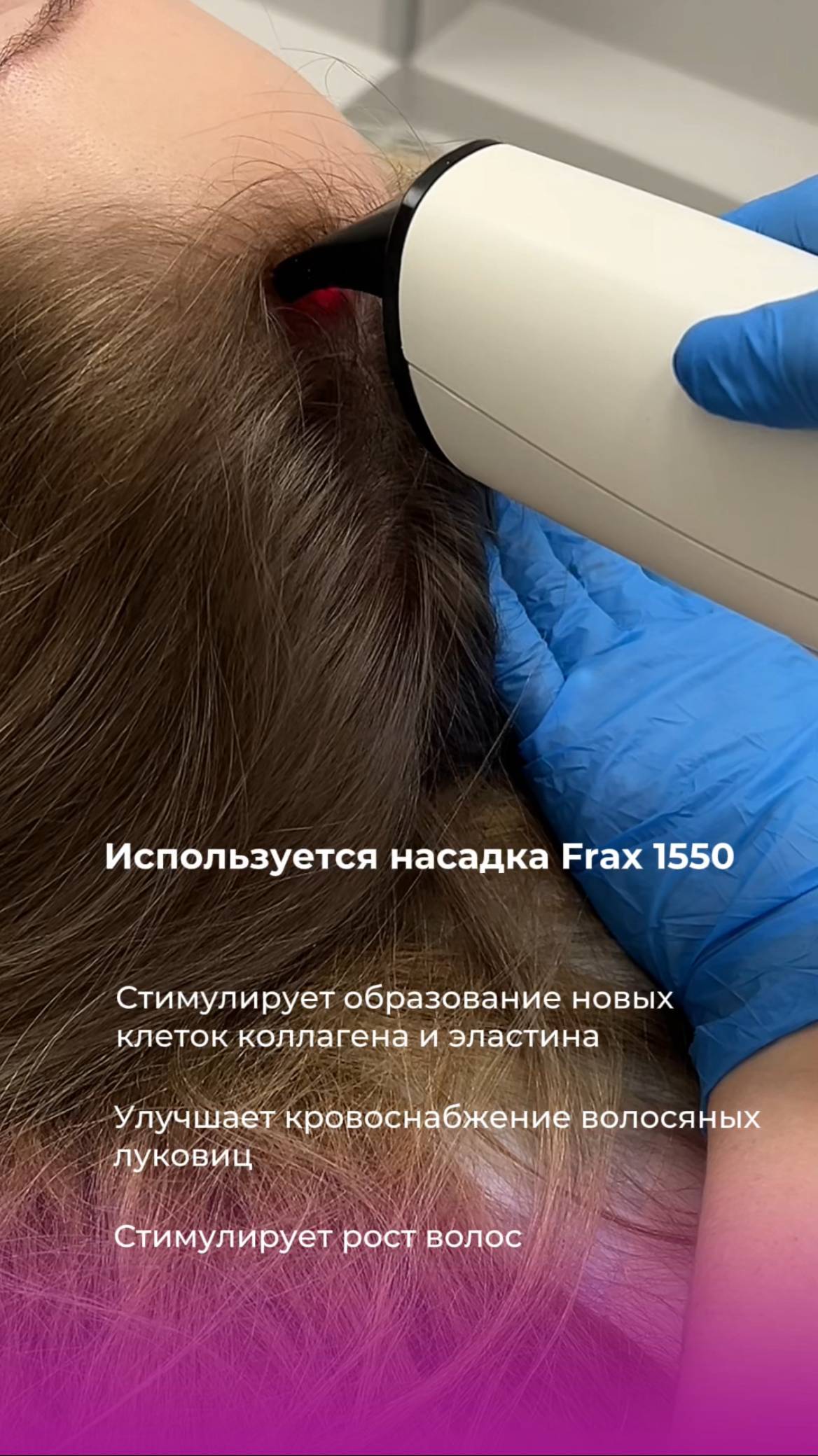 Лазерная терапия кожи головы на аппарате Nordlys Candela (США)