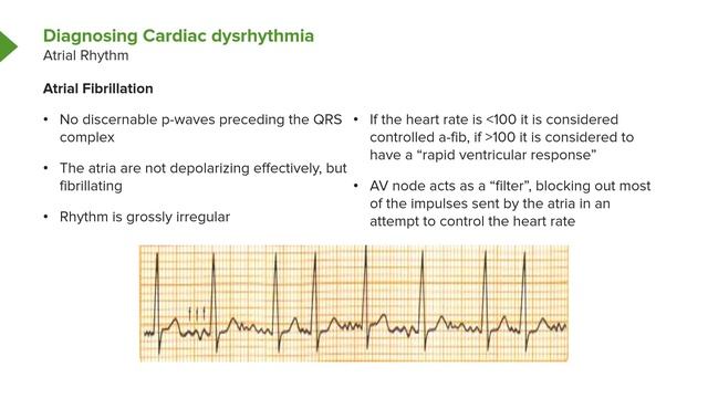 06. Cardiac Dysrhythmia