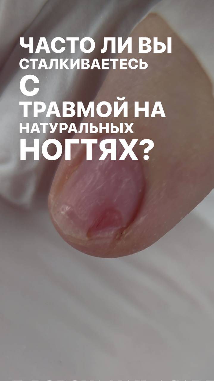 Восстановление ногтя после травмы #shorts #cамара #nails #nailart #дизайнногтей #ногти #маникюр #топ
