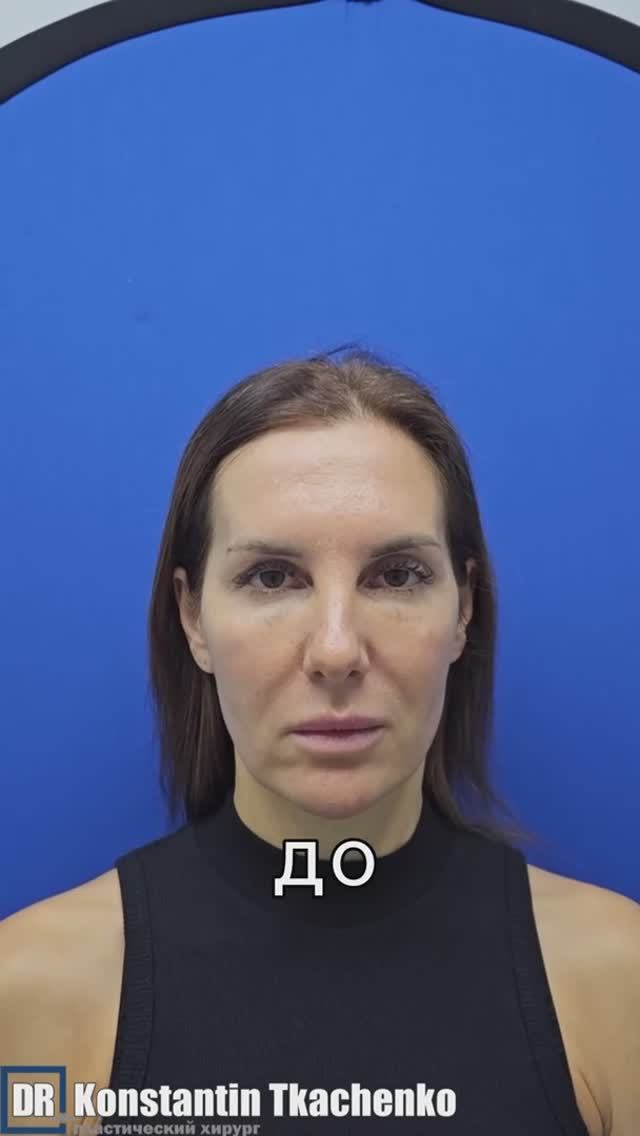 Эндоскопическая подтяжка бровей и лба. В конце смотрите результат