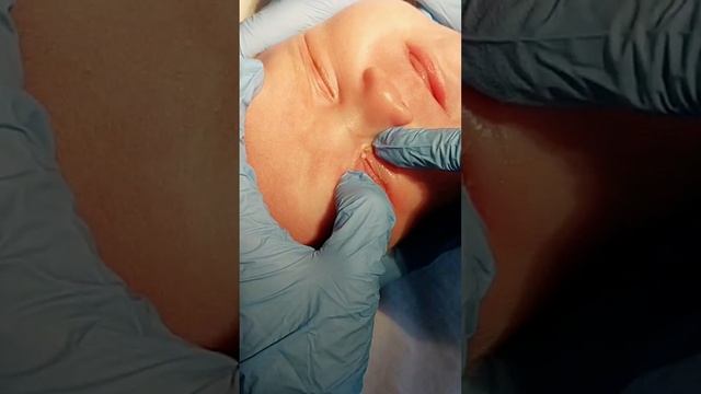 Компрессионная проба слезного мешка