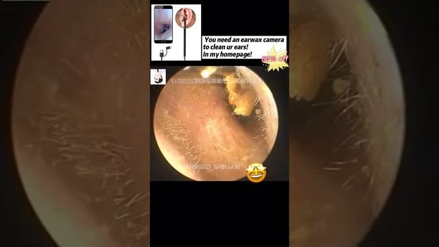 Best Ear Wax Removal & Extraction with Vacuum Remover 真空リムーバーによるにきびの除去と抽出 126