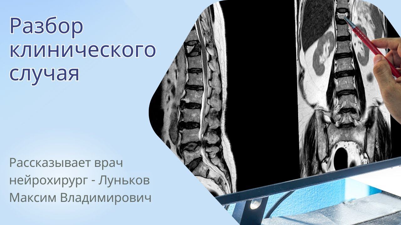 Разбор сложного клинического случая. #межпозвонковаягрыжа #больвспине