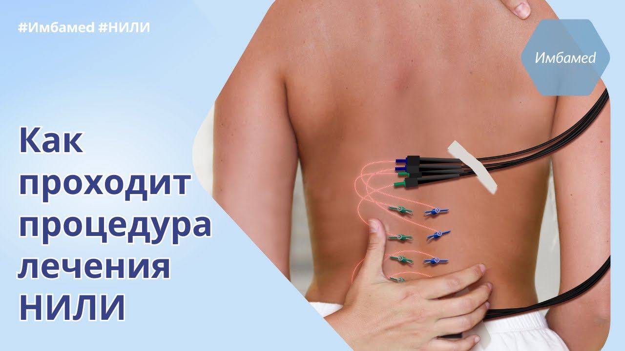 Как проходит процедура лечения низкоинтенсивным лазером. #имбамед #низкоинтенсивныйлазер