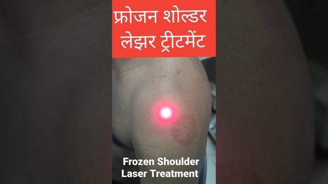 Frozen Shoulder Laser Treatment by Dr.Pravin Singh Physiotherapist @myhomephysio2M