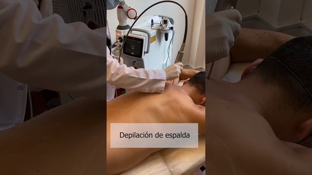 Depilación Laser - Marcación de Barba y espalda - Laser Fotona