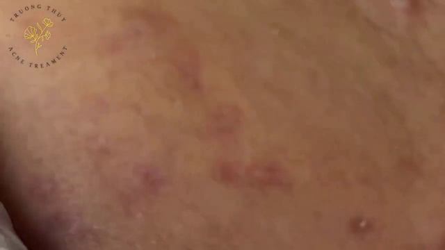 🔥 Выдавливание прыщей | Удаление и выдавливание прыщей и черных точек 2021 | Прыщи выдавливание #01