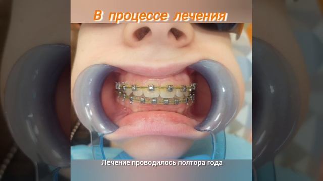 Фотопротокол лечения пациента на брекет-системе. Лечение проводилось 1,5 года.