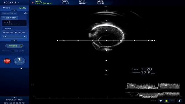 [TCTAP 2018] Coronary Symposium - Live Case & Lecture Session V