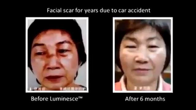 ПОКОЛЕНИЕ МОЛОДОСТИ  LUMINESCE Фото До и После