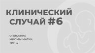 Клинический случай №6. Миома матки, тип 4