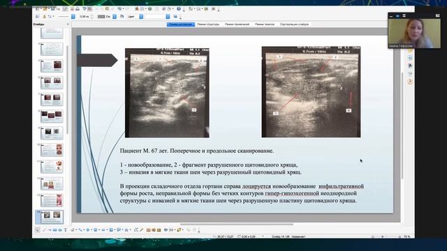 УЗ-диагностика новообразований гортани с применением интервенционных методик