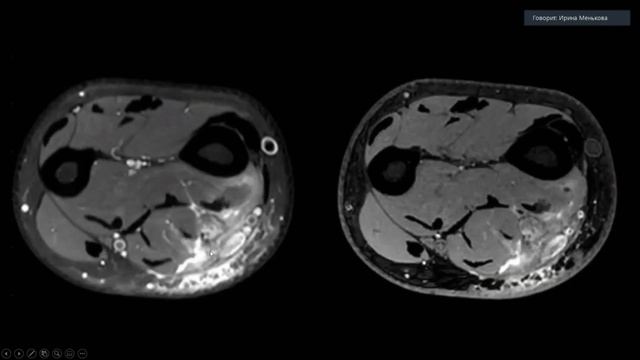 Менькова И.С. МРТ в диагностике компрессионных и травмат. нейропатий на примере клинических случаев