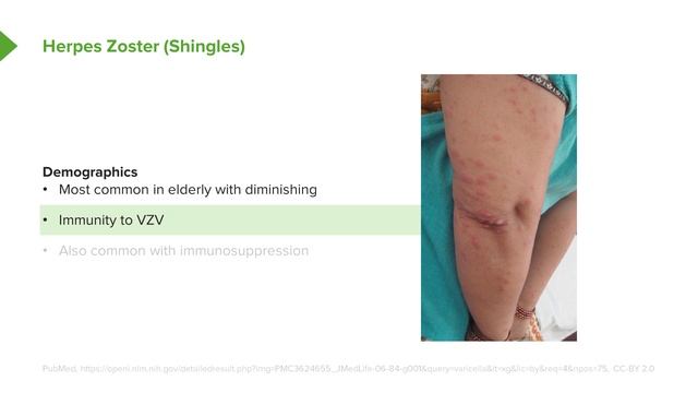 03. Herpes Zoster (Shingles)