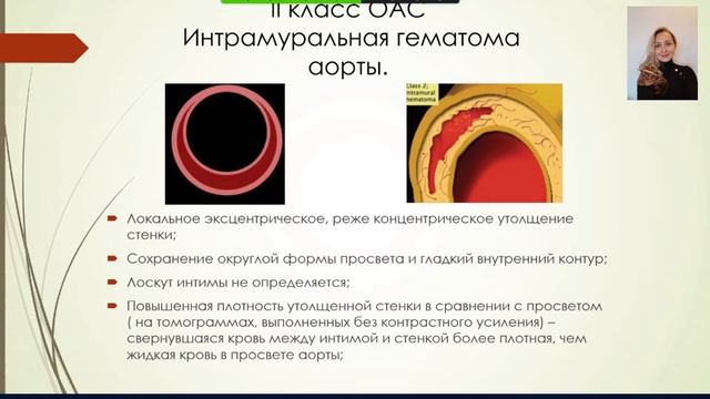 Николаева Е.В. МСКТ-диагностика острого аортального синдрома