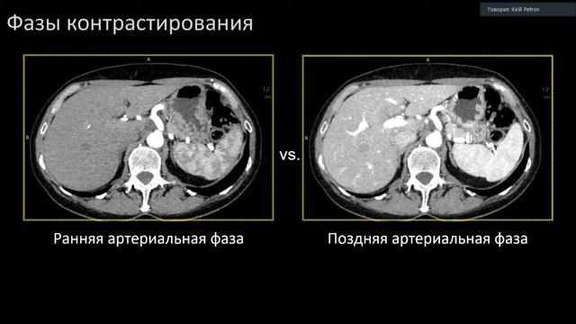 Петров К.С. Протоколы сканирования брюшной полости с контрастированием, как не допустить ошибки?