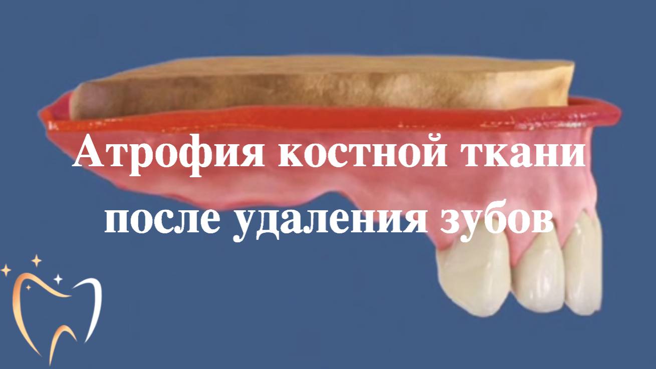 💥Атрофия костной ткани