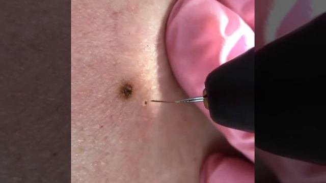 Удаление папиллом методом Ablase