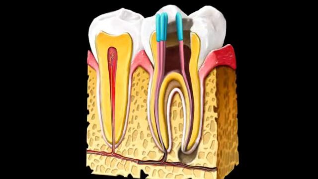 Root Canal Treatment, Molar 3D Animation