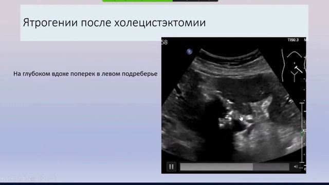 Ветшева Н.Н. Что может сказать УЗИ о состоянии желчных протоков?