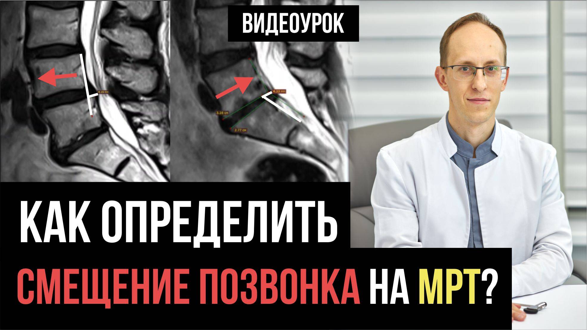 Видеоурок: антелистез и ретролистез в поясничном отделе позвоночника. Как посмотреть на МРТ?