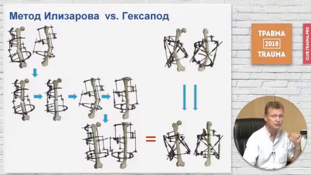 Основы биомеханики черескостного остеосинтеза (2)